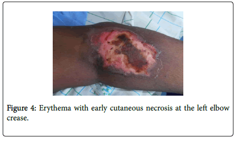 clinical-trials-Erythema-early