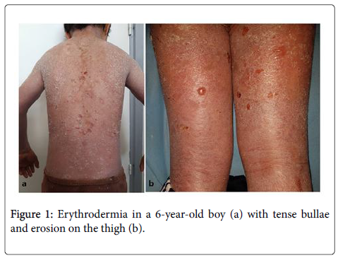 clinical-trials-Erythrodermia