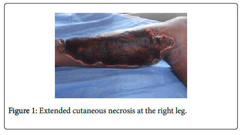 clinical-trials-Extended-cutaneous
