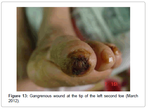 clinical-trials-Gangrenous-wound