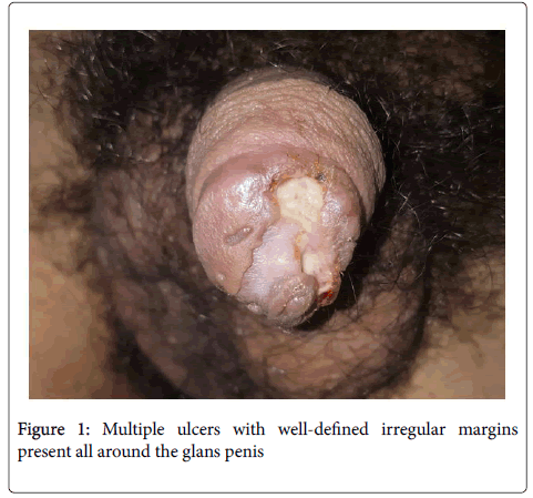 clinical-trials-Multiple-ulcers