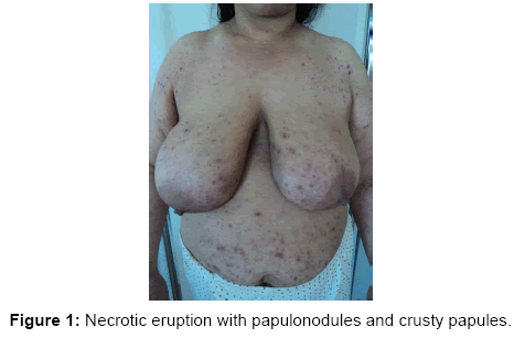 clinical-trials-Necrotic-eruption-papulonodules