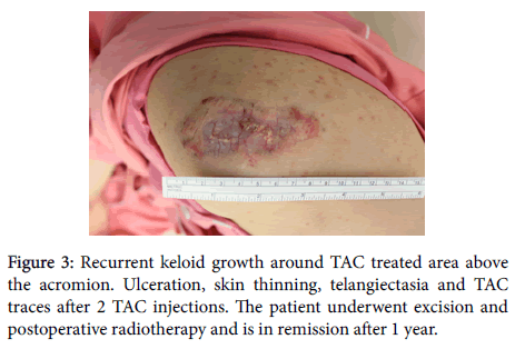 clinical-trials-Recurrent-keloid