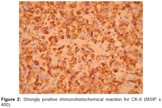 clinical-trials-Strongly-positive-immunohistochemical