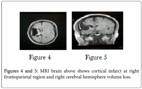 clinical-trials-cerebral-hemisphere