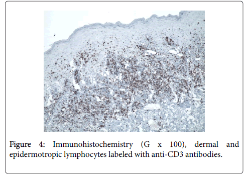 clinical-trials-epidermotropic-lymphocytes