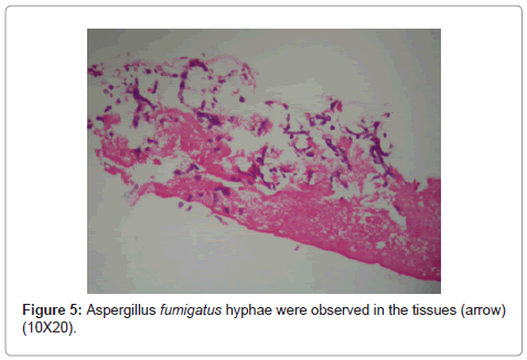 clinical-trials-fumigatus-hyphae