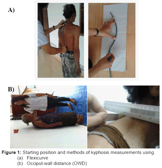 clinical-trials-kyphosis-measurements