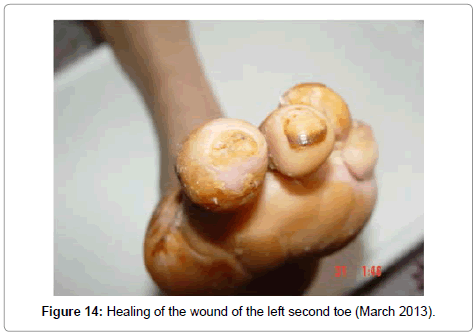 clinical-trials-left-second-toe