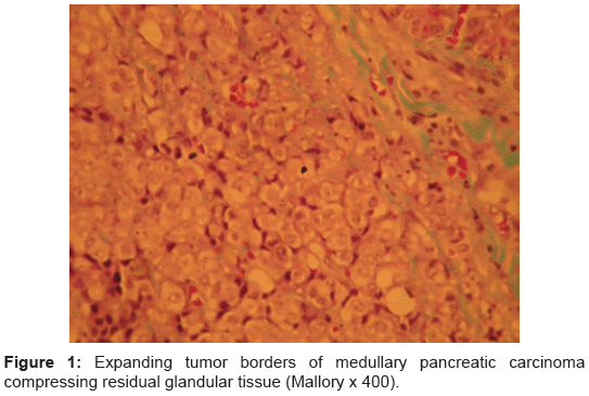 clinical-trials-medullary-pancreatic-carcinoma