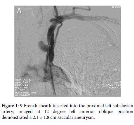 clinical-trials-subclavian-artery