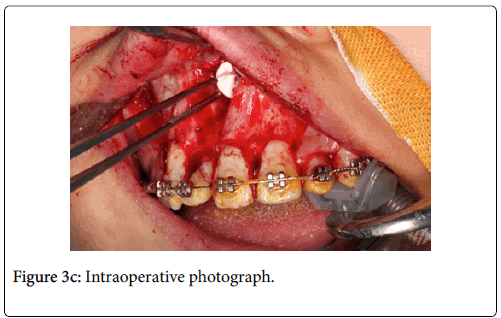 clinical-trials-therapy-Intraoperative-photograph