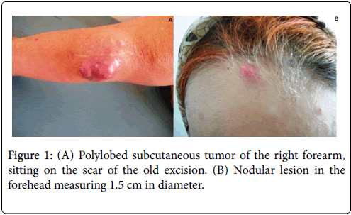 clinical-trials-therapy-Nodular-lesion