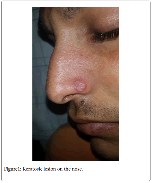 clinical-trials-therapy-lesion-nose