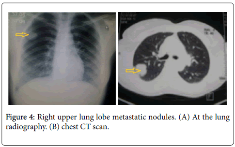 clinical-trials-therapy-lung-lobe