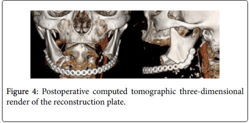 clinical-trials-therapy-reconstruction-plate