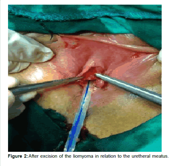 Urethral Leiomyoma in Females: Report of 3 Cases