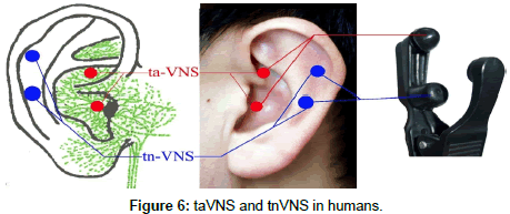 Transcutaneous auricular vagus nerve stimulation as a potential novel  treatment for polycystic ovary syndrome