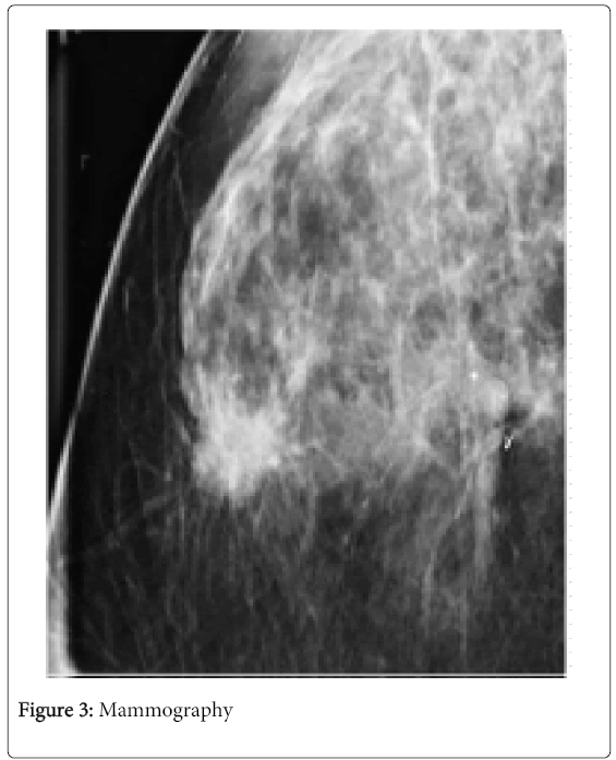 drug-designing-Mammography