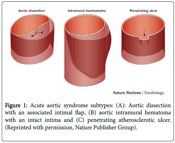 emergency-medicine-acute-aortic-syndrome