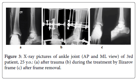 Tibia Ring Ilizarov External Fixation for Clubfoot Treatment - China  External Fixator, Ilizarov External Fixator