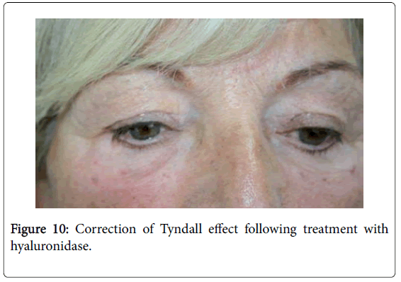 emergency-medicine-correction-Tyndall-effect