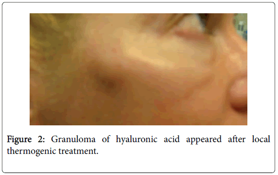 emergency-medicine-granuloma-hyaluronic-acid