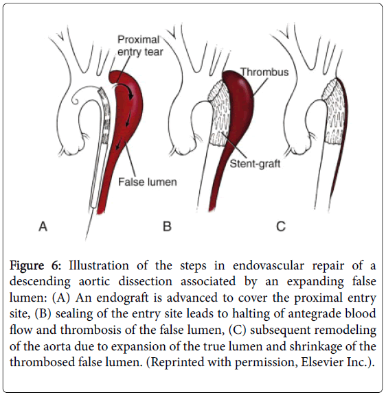 emergency-medicine-illustration-steps-aortic