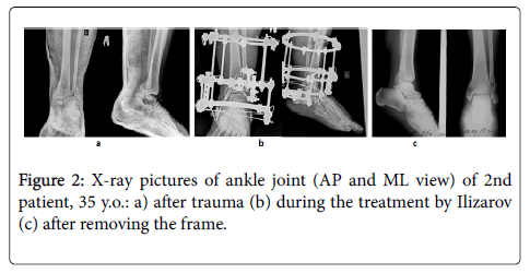 Posttraumatic Reconstruction of the Ankle Using the Ilizarov