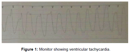 emergency-medicine-monitor-ventricular-tachycardia