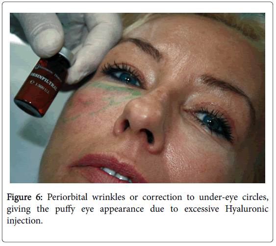 emergency-medicine-periorbital-wrinkles