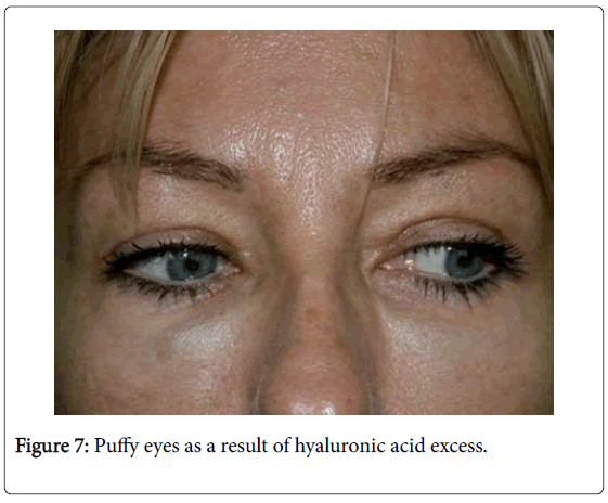 emergency-medicine-puffy-eyes-hyaluronic