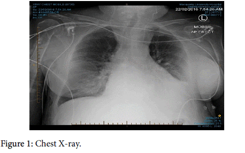 endocrinology-metabolic-syndrome-Chest-X-ray