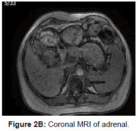 endocrinology-metabolic-syndrome-Coronal-MRI