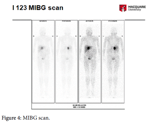 endocrinology-metabolic-syndrome-MIBG-scan