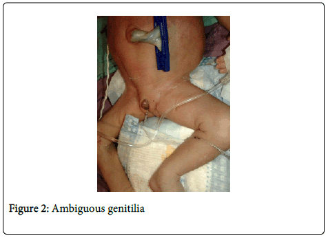 gynecology-Ambiguous-genitilia