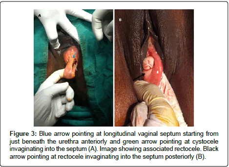 gynecology-Blue-arrow