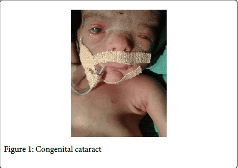 gynecology-Congenital-cataract