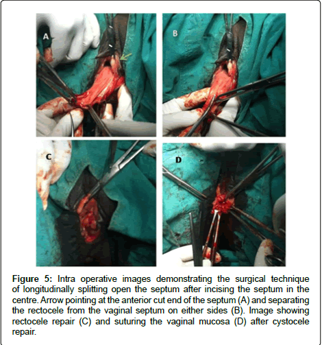 gynecology-Intra-operative
