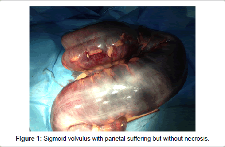 gynecology-Sigmoid-volvulus