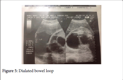 gynecology-bowel-loop