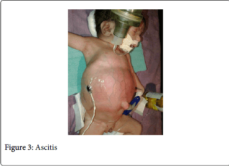 gynecology-obstetrics-Ascitis