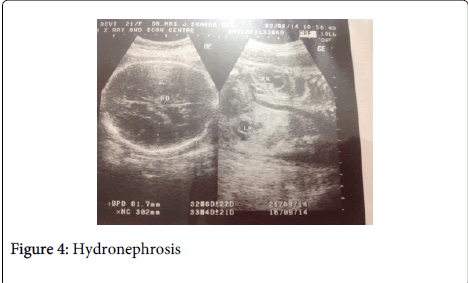gynecology-obstetrics-Hydronephrosis