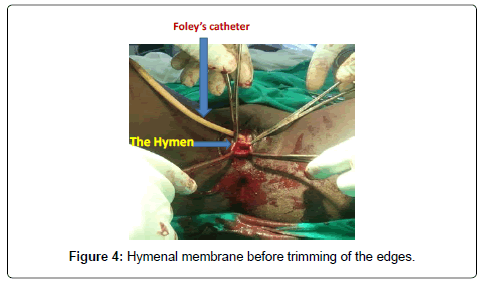 gynecology-obstetrics-Hymenal-membrane