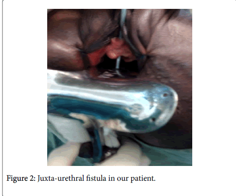gynecology-obstetrics-Juxta-urethral