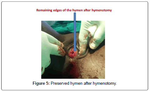 gynecology-obstetrics-Preserved-hymen