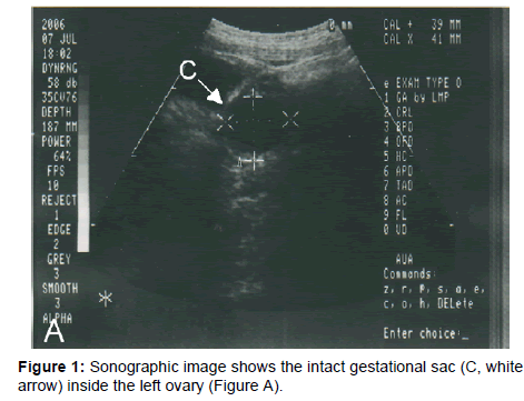 gynecology-obstetrics-Sonographic-intact-gestational
