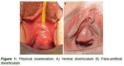 Female Urethral Diverticulum: Diagnosis, Treatment and Outcome
