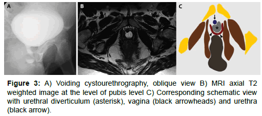 A and B) Diverticulum tracted to approach de neck dissection C