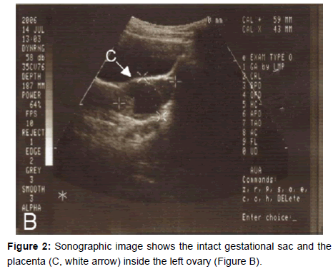 gynecology-obstetrics-intact-gestational-sac